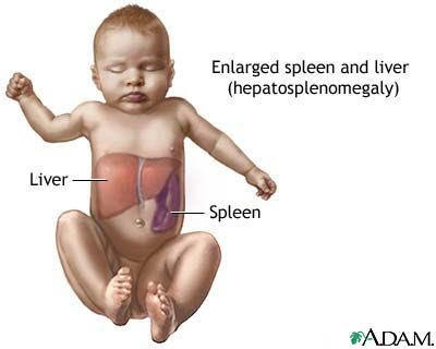 Splenomegaly Healthing Ca