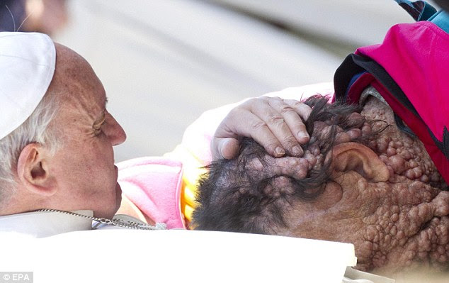Act of kindness: Pope Francis (left) comforts a man covered in boils in Saint Peter's Square at the end of his General Audience in Vatican City