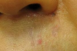 ケロイドや顔の傷を消したいなら世田谷の二子玉川ヤスダクリニック