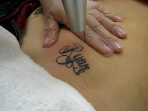 Laser Tattoo Removal by Medispa Institute in Houston, Texas,