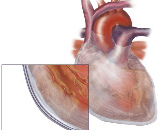 Autoimmune Heart Inflammation - Does Gluten Play a Role ...