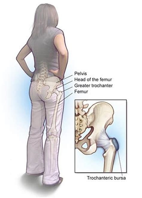 Learn 10 common causes of knee pain and get relief. Hip-Bursitis - Michael J. Latteier, M.D.