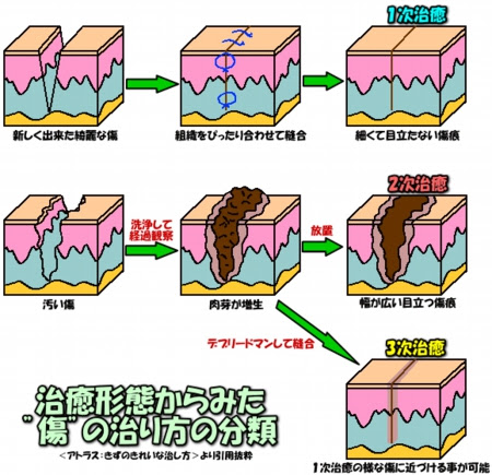 傷 跡 のキレイな治し方