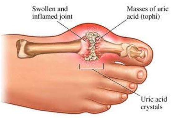 4 Tanda Gout untuk Dikenalpasti  azeniahmad.com