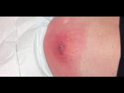 Cellulitis and abscess