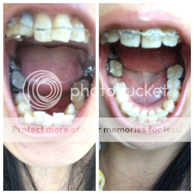 Braces at 30 - FINALLY! - Page 2 - Metal Mouth Message Board