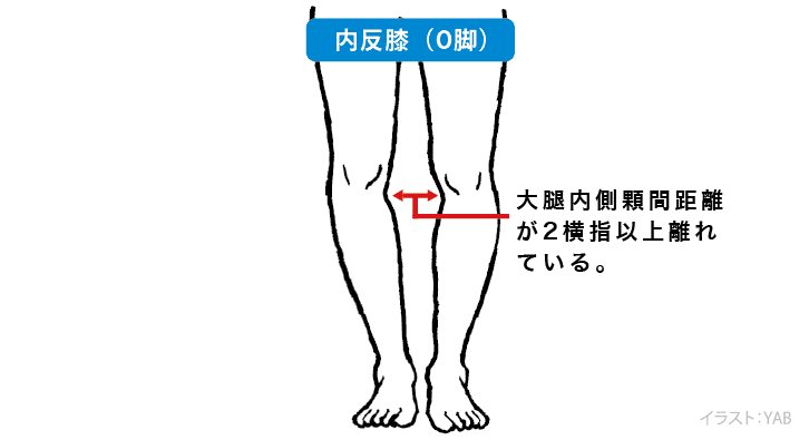 O脚いろいろ O脚の矯正 よみもの Com 誠文堂新光社