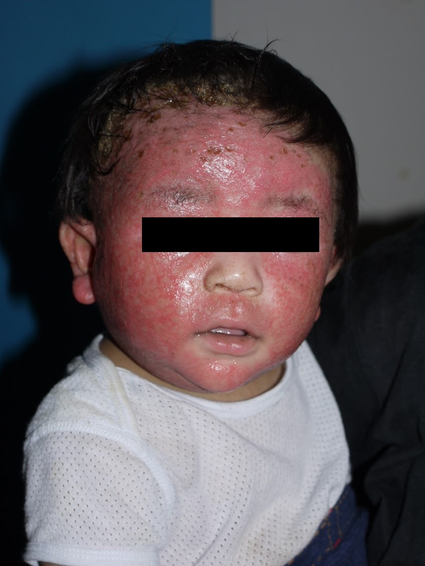 乳児アトピー性皮膚炎2