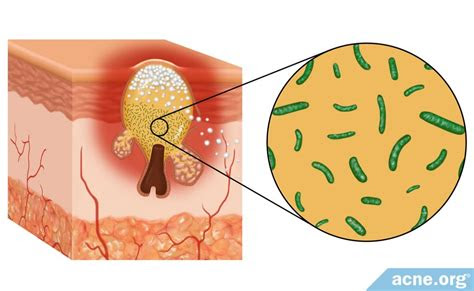role  bacteria  acne acneorg