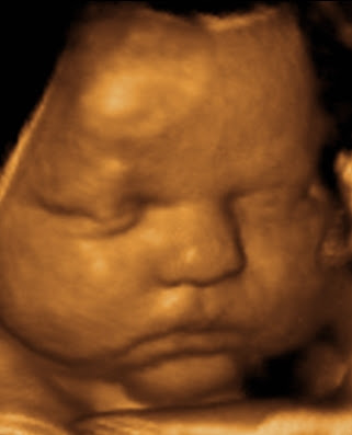 3D ultrasound and 4D