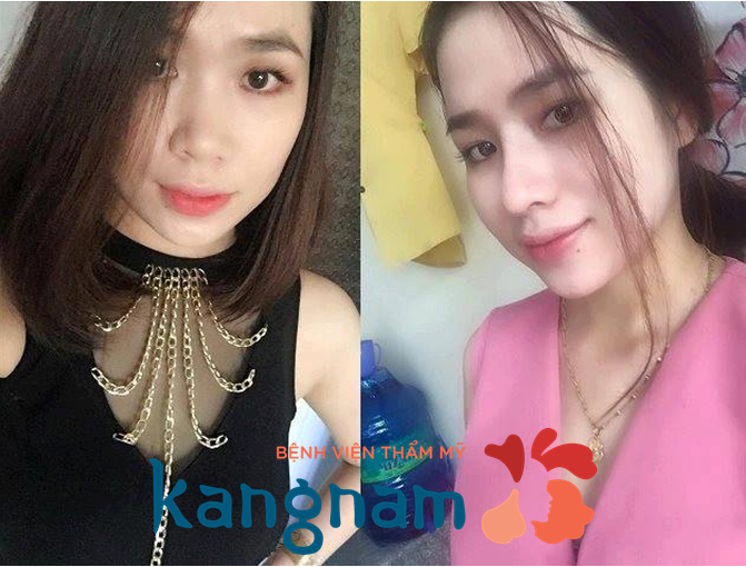 nâng mũi bằng sụn sườn 4