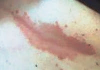 Was Ist Das Unter Der Brust Mit Bild Dermatologie Med1