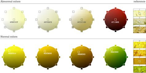 See the stool colour chart at the uk children's liver disease foundation website. diagnostico de la atresia de vias biliares the story of bileless lily