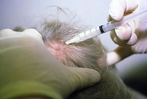 A man receives a corticosteroid injection to treat alopecia areata.