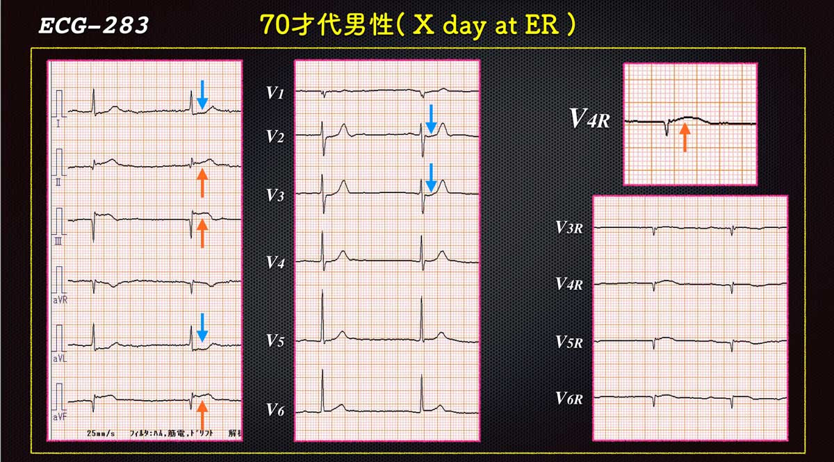 Ecg 2 Answer Cardio12のecgブログ
