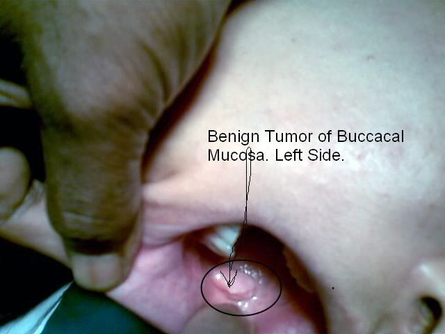 type 2 diabetes mellitus and hypertension  | clinicianonnet.blogspot.com