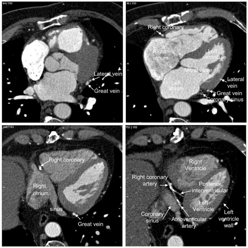 Labelling of heart structures