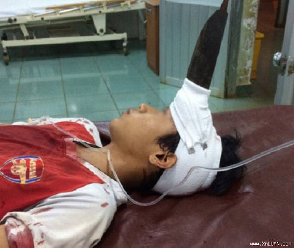 Bé trai 12 tuổi bị dao cắm giữa trán khi đùa với em