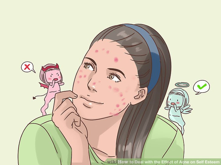 Deal with the Effect of Acne on Self Esteem Step 1.jpg