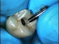 Stripped head while tightening screw – recently placed – another implant rescue 2/2