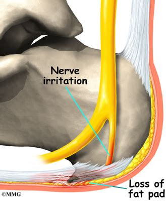 Plantar fasciitis is an inflammation of the tissue in the foot used for walking. Plantar Fasciitis | eOrthopod.com
