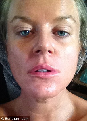 Marie Adams after having the fillers