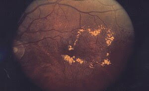 Diabetic macular edema.
