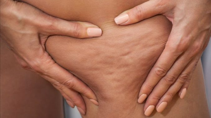 combattere cellulite
