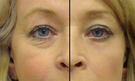 eye secrets anti wrinkle patch      years
