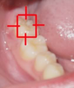 Wisdom tooth