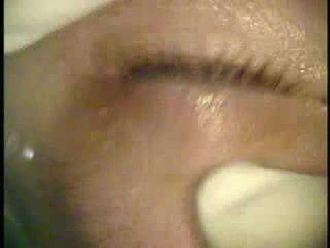 recurrent corneal erosion treated with amoils rotary brush