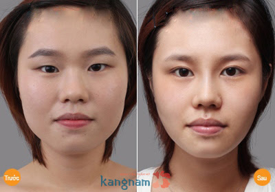 Mở rộng đuôi mắt7