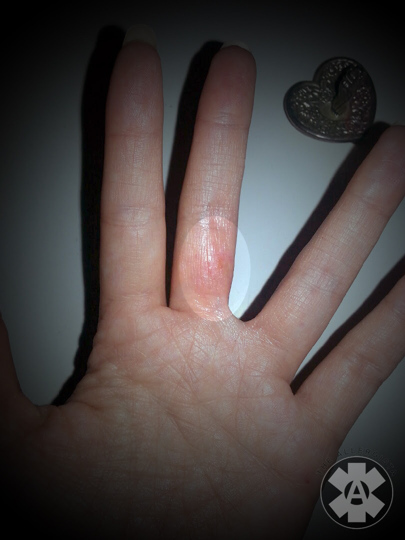 Wedding ring allergic