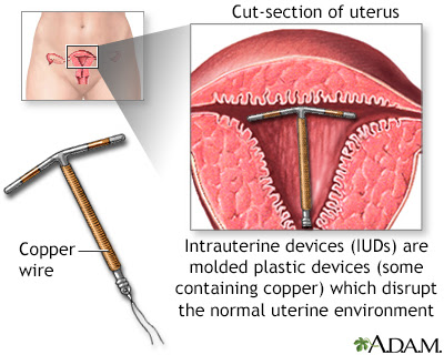 Uterine Fibroids And Hysterectomy
