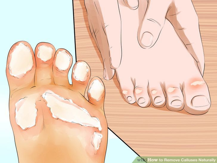 Remove Calluses Naturally Step 2 Version 2.jpg