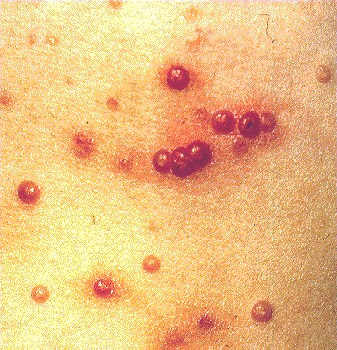 Molluscum on Skin Picture  Molluscum Contagiosum Treatment