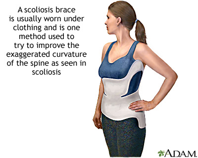 Scoliosis Penn Medicine