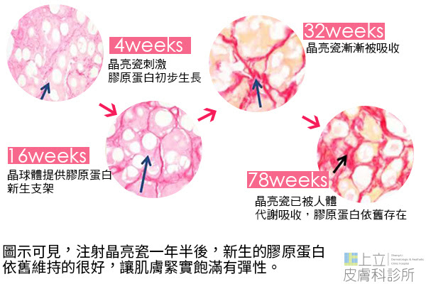上立皮膚科 費用 林上立 價格 林上立 評價  液態拉皮上立提 液態拉皮 推薦液態拉皮晶亮瓷微晶瓷晶亮瓷推薦晶亮瓷價格晶亮瓷術後晶亮瓷微晶瓷微晶線拉提04.jpg
