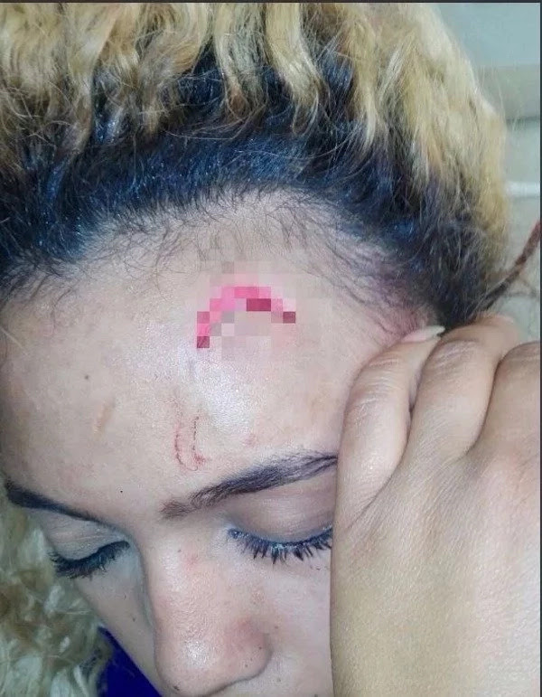Gabriella Engels displays the cut on her forehead. Photo: Twitter/Gabriella Engels