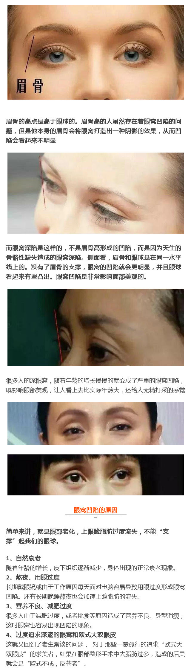 你可能误会了丨眼窝深和眉骨高不是一回事 中国眼科网 Www Yanke360 Com