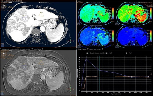 Trường hợp uống rượu bia nhiều được phát hiện ung thư gan sớm bằng MRI Primovist