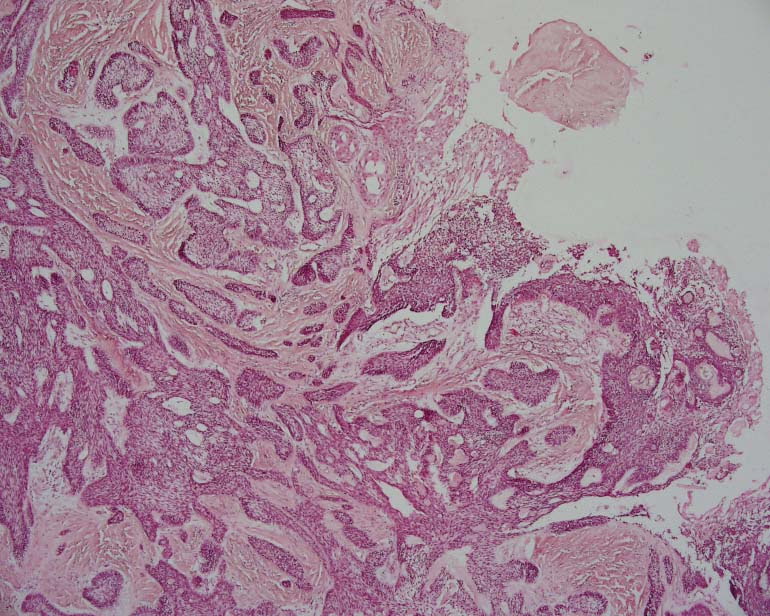 Disease