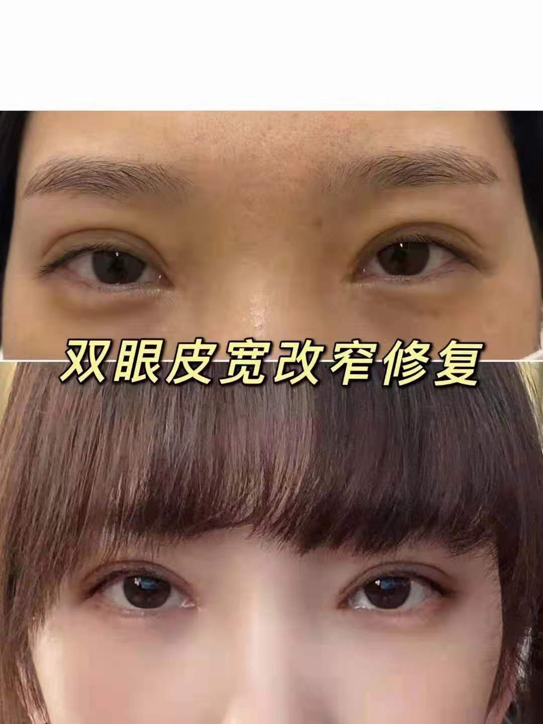彭昌福修复双眼皮技术好吗 彭昌福眼修复简介预约 整容资讯网