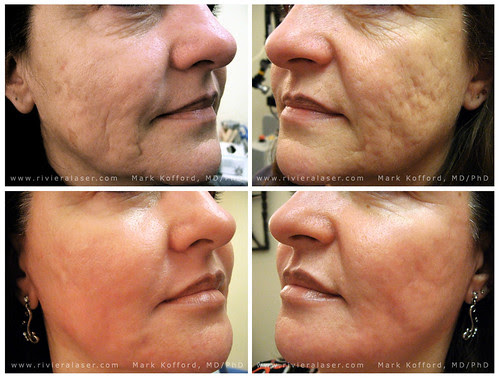 MAKEUP TO COVER ACNE SCARS - MAKEUP TO COVER