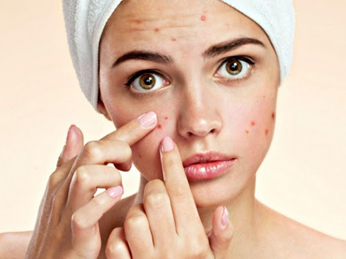 Da bị viêm do nặn mụn đầu đen.