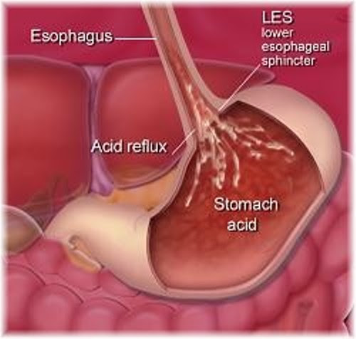10 Facts about Acid Reflux  Fact File