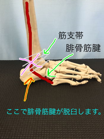 サッカー バスケットボールなど球技全般でおこりやすい 腓骨筋腱脱臼 ひこつきんけんだっきゅう 神奈川県川崎市の接骨院はむさしなかはら接骨院