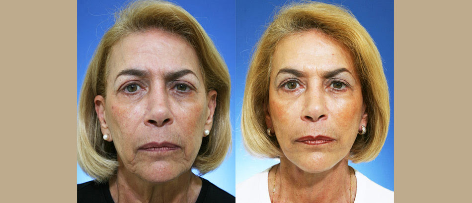 free boca raton plastic surgery