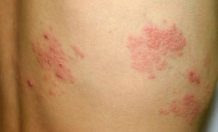 帯状ほうしん 豊橋のまひろ皮ふ科クリニック