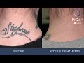 Tattoo Laser Removal : Laser Tattoo Removal Specialists Toronto - Rice Cosmetic : We did not find results for: